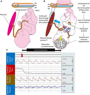 Placental Transfusion for Asphyxiated Infants